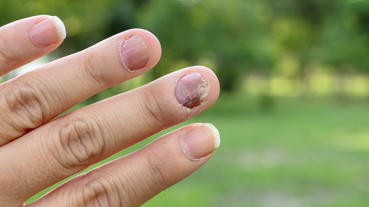 Bệnh Nấm Móng Thường Gặp Vào Mùa Hè